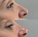 Preenchimento Facial para Harmonização Natural