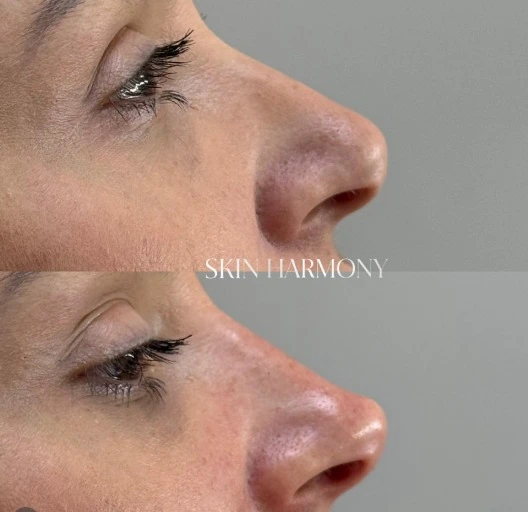 Preenchimento Facial para Harmonização Natural