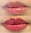 Preenchimento Facial para Harmonização Natural