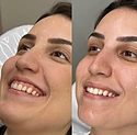Toxina Botulínica para linhas de expressão