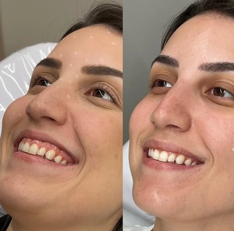 Toxina Botulínica para linhas de expressão