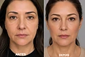 Lifting Facial sem corte
