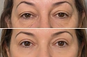 Lifting Facial sem corte