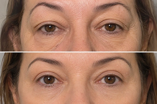 Lifting Facial sem corte