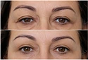 Lifting Facial sem corte