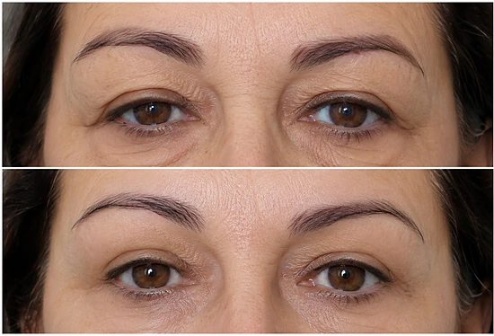 Lifting Facial sem corte