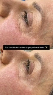 Lifting Facial sem corte