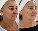 Lifting Facial sem corte